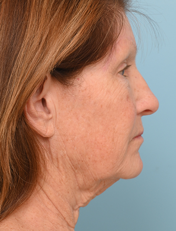Face Lift/Neck Lift