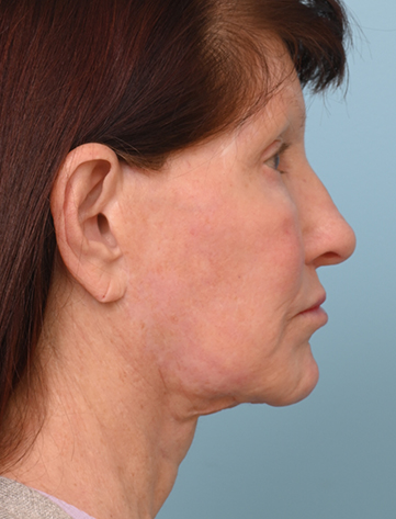 Face Lift/Neck Lift