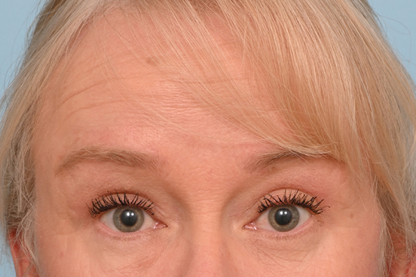 Brow Lift