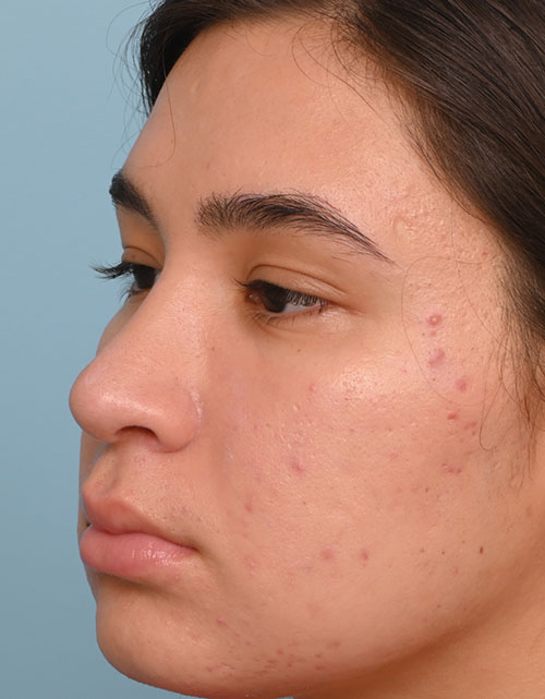 Rhinoplasty