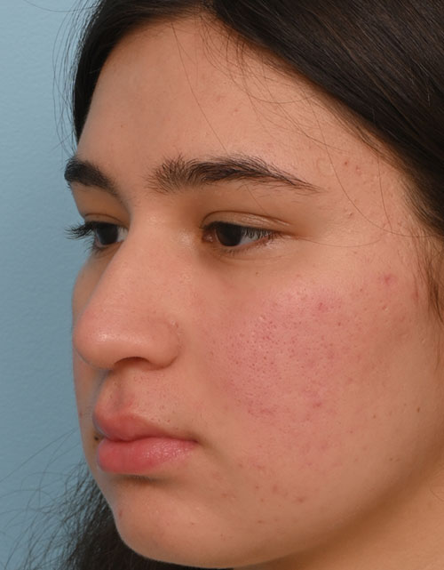 Rhinoplasty