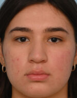 Rhinoplasty