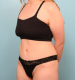 Tummy Tuck