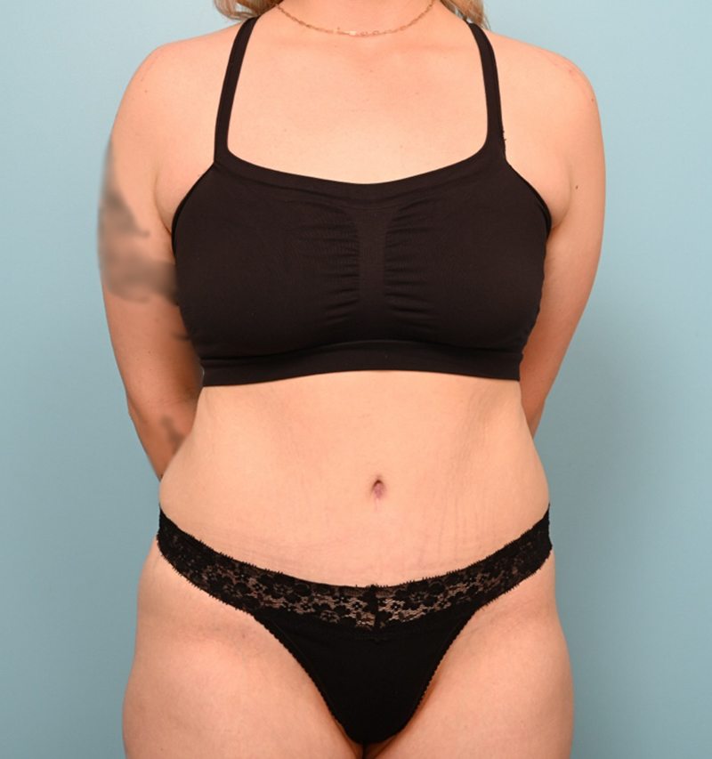 Tummy Tuck