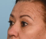 Eye Rejuvenation