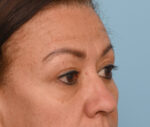 Eye Rejuvenation