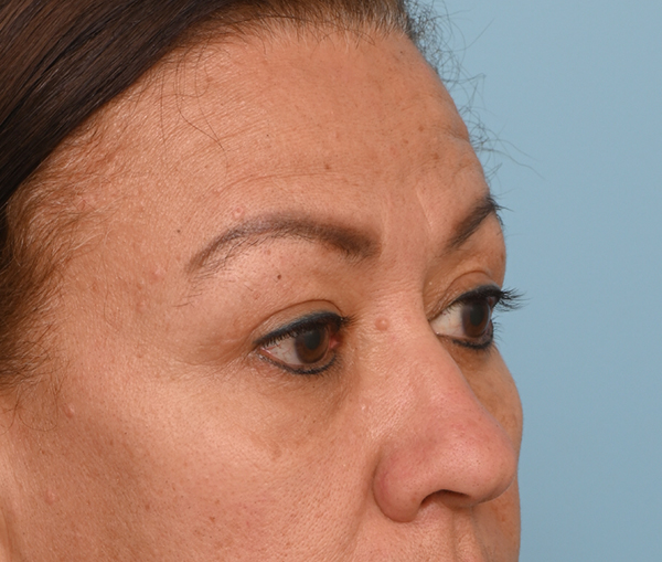Eye Rejuvenation