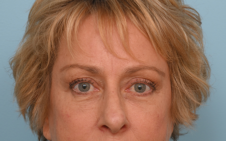 Brow Lift