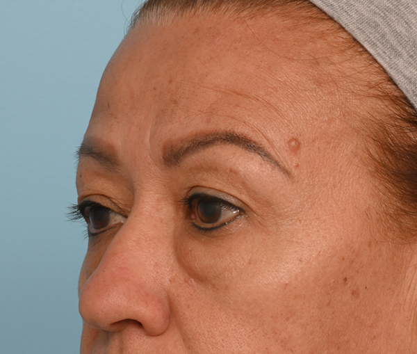 Eye Rejuvenation