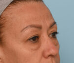 Eye Rejuvenation
