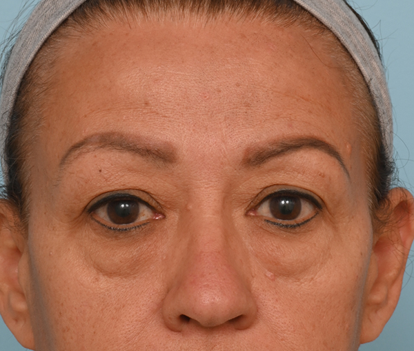 Eye Rejuvenation