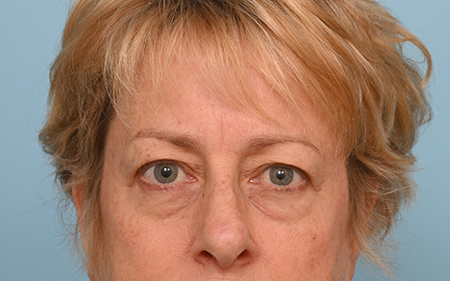 Brow Lift