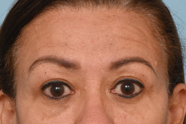 Brow Lift