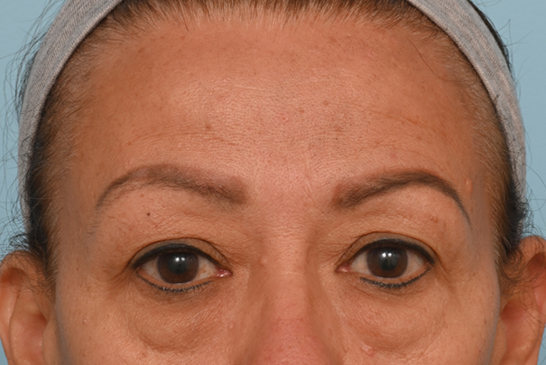 Brow Lift