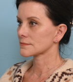 Face Lift/Neck Lift