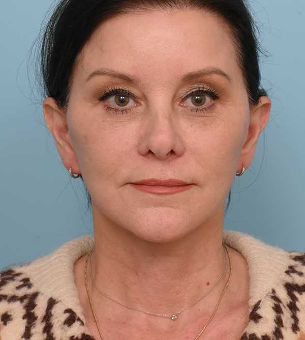 Face Lift/Neck Lift