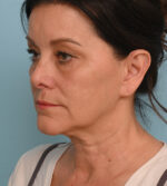 Face Lift/Neck Lift
