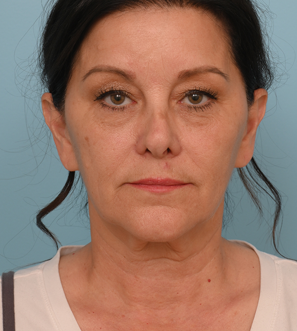 Face Lift/Neck Lift