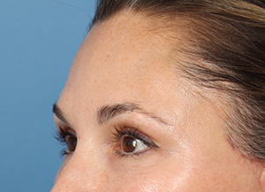 Brow Lift