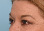 Brow Lift