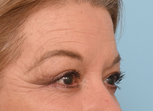 Brow Lift