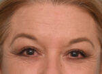Brow Lift