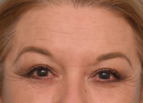 Brow Lift
