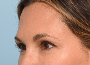 Brow Lift