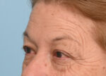 Brow Lift