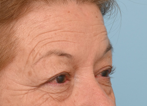 Brow Lift