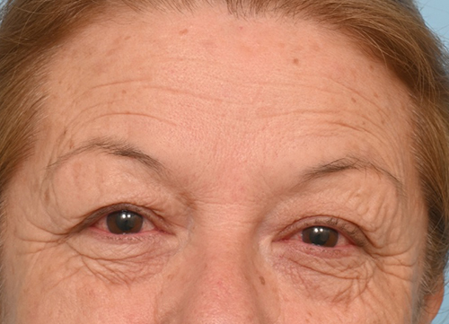 Brow Lift