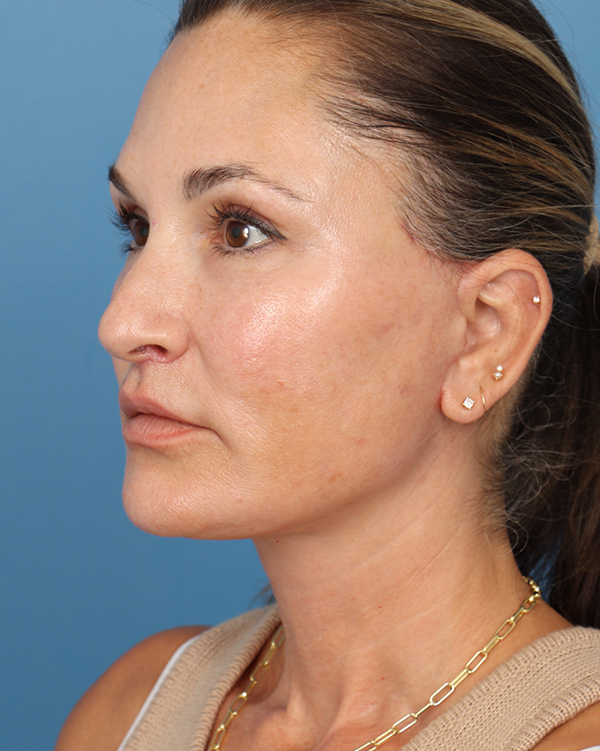 Face Lift/Neck Lift