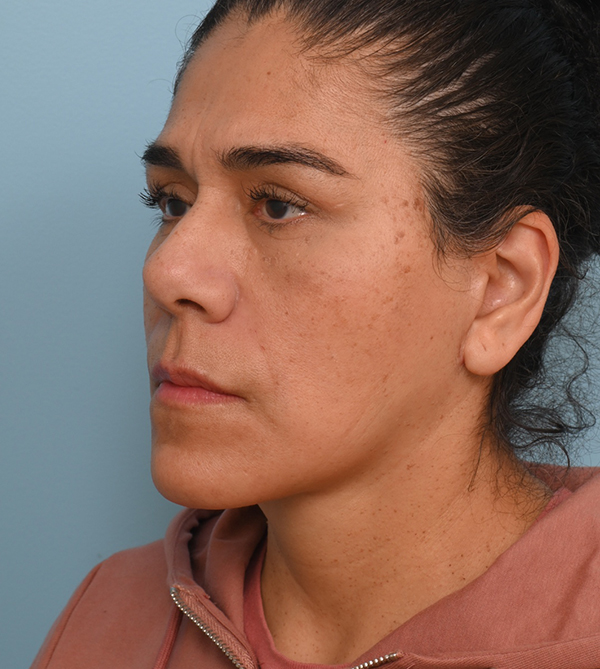 Face Lift/Neck Lift