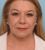 Face Lift/Neck Lift