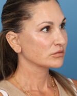 Face Lift/Neck Lift
