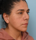 Face Lift/Neck Lift