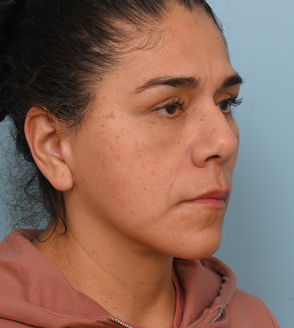 Face Lift/Neck Lift