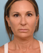 Face Lift/Neck Lift