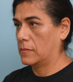 Face Lift/Neck Lift