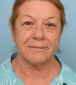 Face Lift/Neck Lift