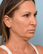Face Lift/Neck Lift