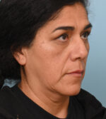 Face Lift/Neck Lift