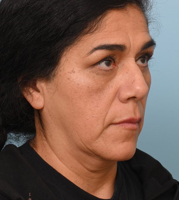 Face Lift/Neck Lift