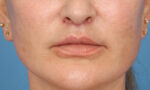 Lip Lift