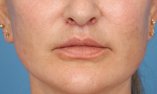 Lip Lift