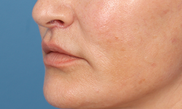 Lip Lift