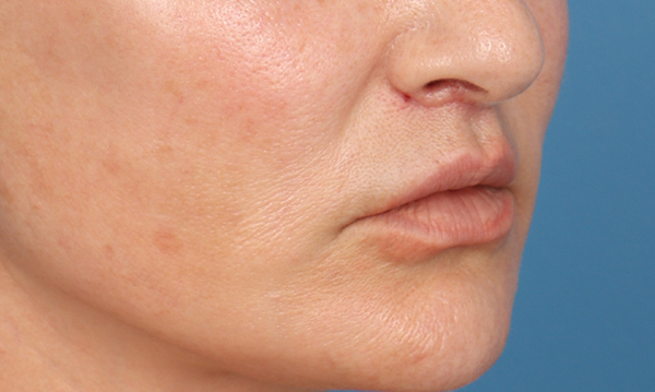 Lip Lift