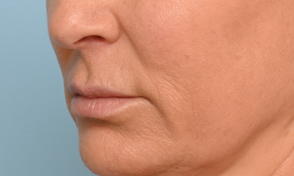 Lip Lift