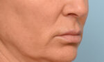 Lip Lift