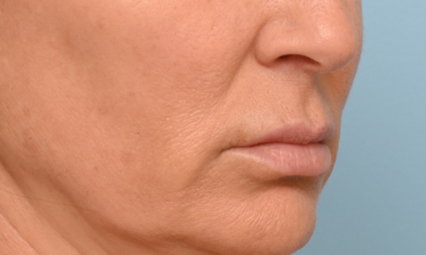 Lip Lift